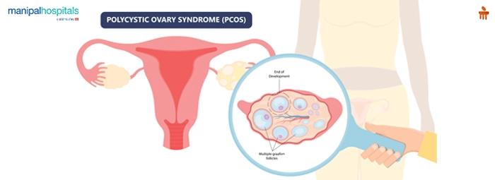 Myths and Facts About PCOS (Polycystic Ovary Syndrome)