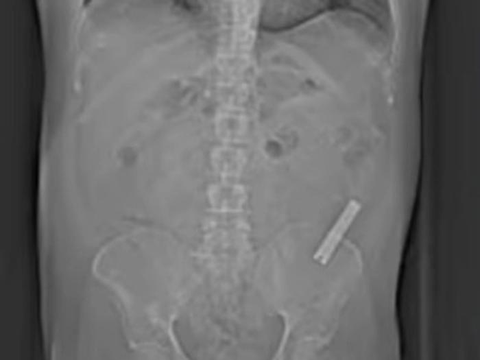 Swallowing Inedible Objects: How Harmful It Can Be?