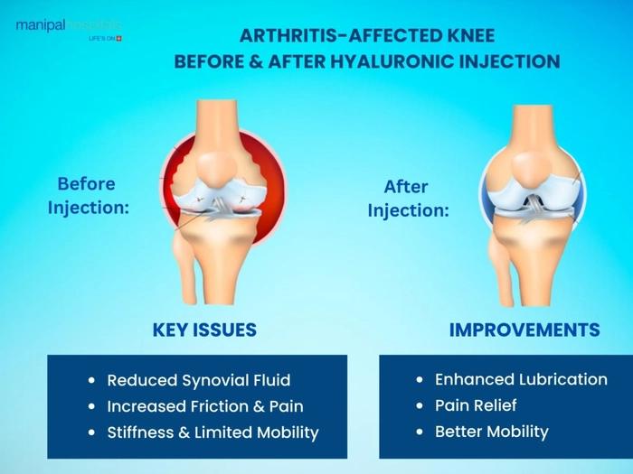 Hyaluronic Acid Injections for Arthritis Pain Relief